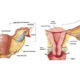 Prevenzione del tumore del collo dell'utero